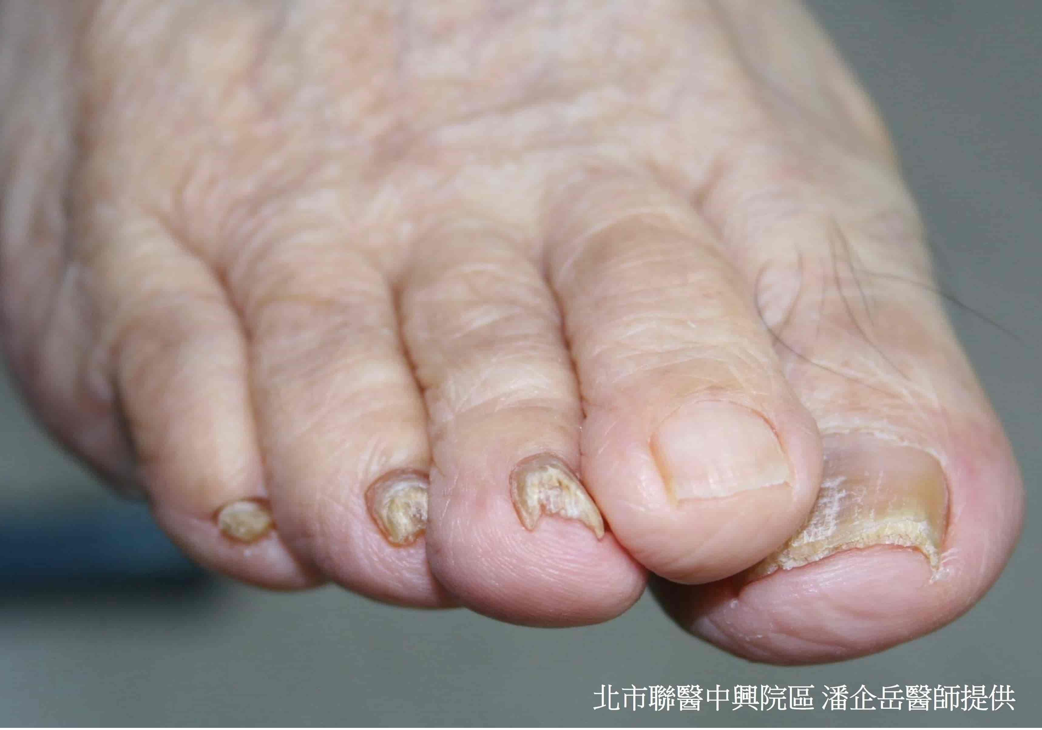 灰指甲_60歲後常見6種皮膚問題