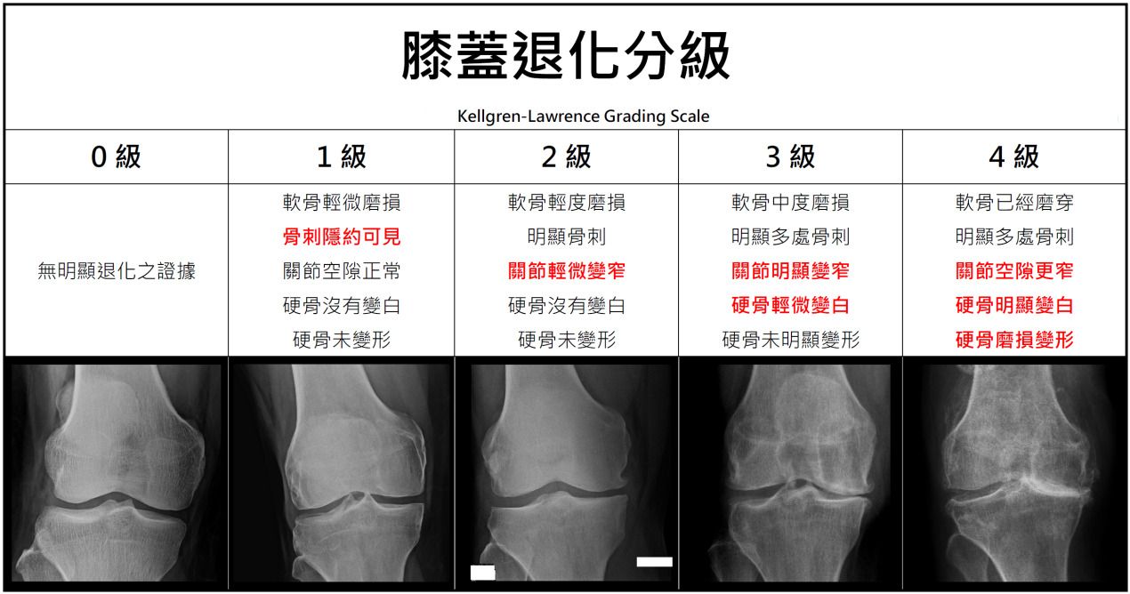 吳彥堂醫師_退化性關節炎分級