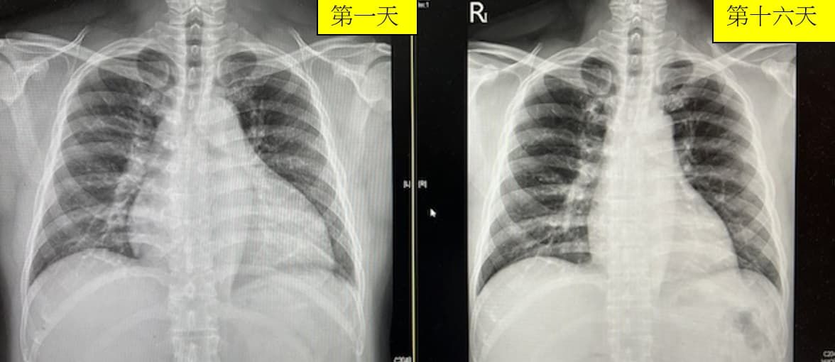 臺北市立聯合醫院-胸部X光照片(圖片由曾梓維主任提供)