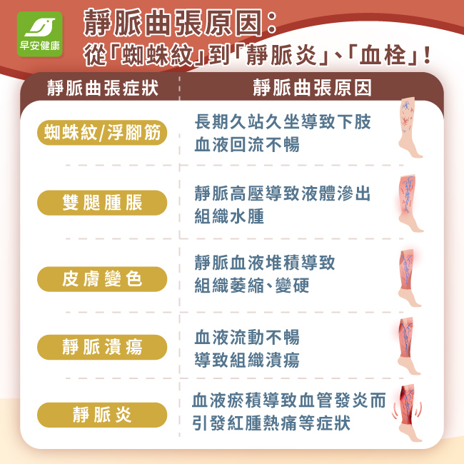 靜脈曲張症狀原因