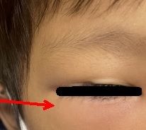 新竹台大:鼻竇炎併發隔膜前(眼眶周圍)蜂窩性組織炎