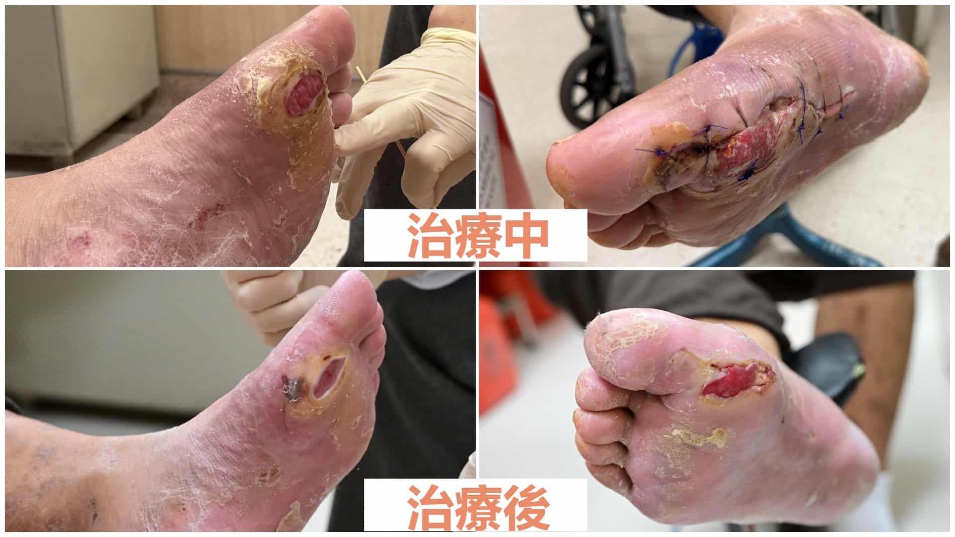 亞洲大學附屬醫院 糖尿病足