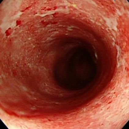 潰瘍性結腸炎的大腸黏膜(李柏賢醫師提供)
