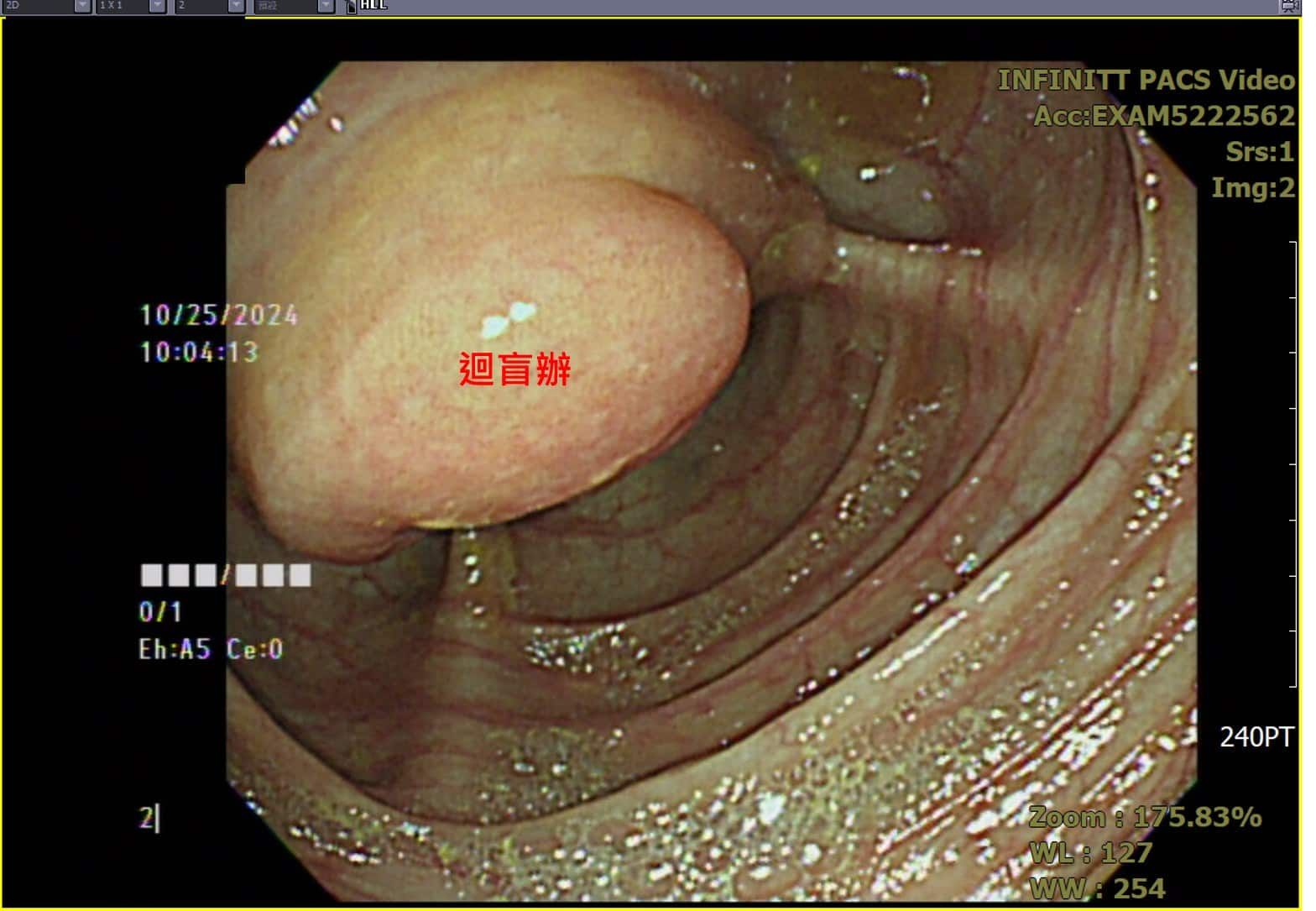 方冠傑醫師_大腸鏡檢查