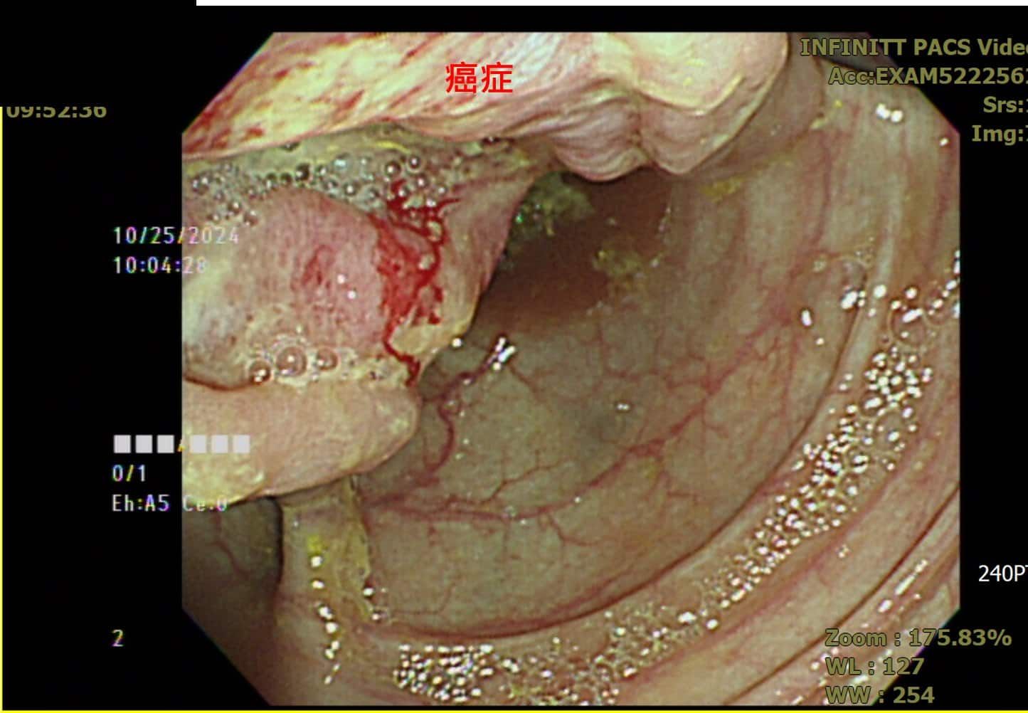 方冠傑醫師_大腸鏡檢查