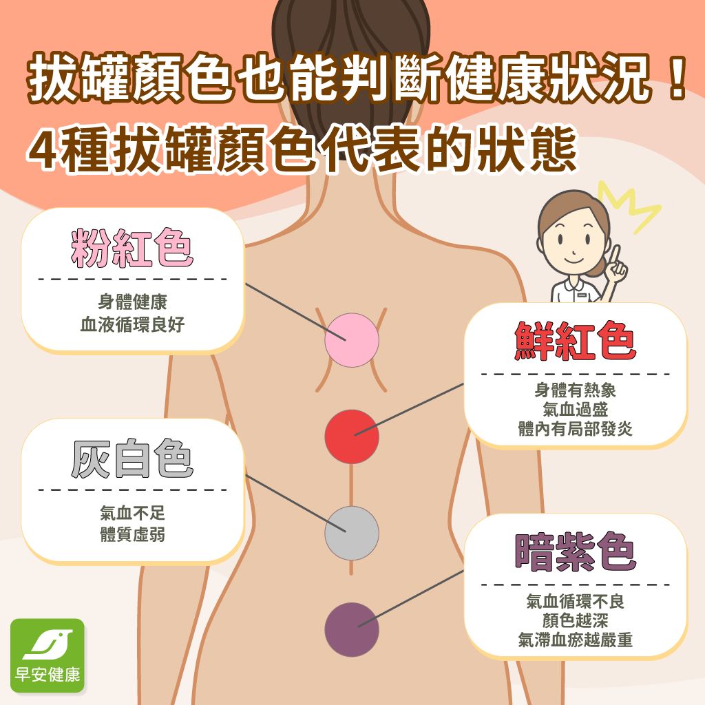 拔罐是什麼？拔罐好處、顏色＆原理、禁忌與適合對象