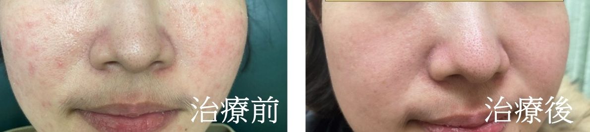 亞大醫院_玫瑰斑
