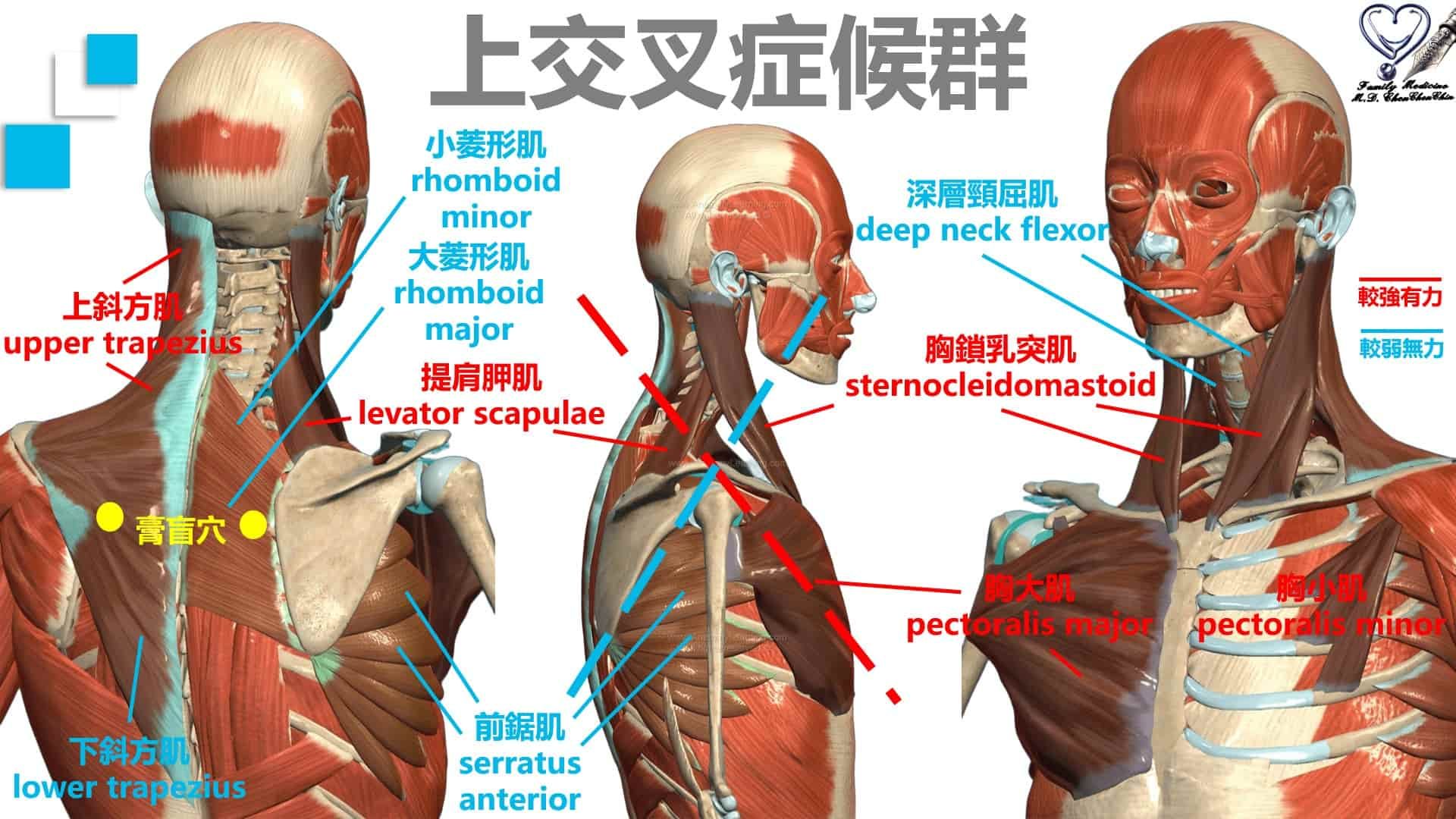陳承勤醫師_上交叉症候群