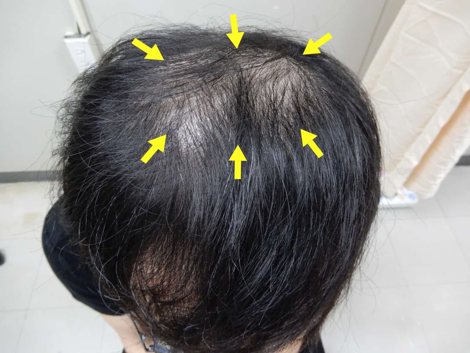 澄清醫院_雄性禿_梅毒