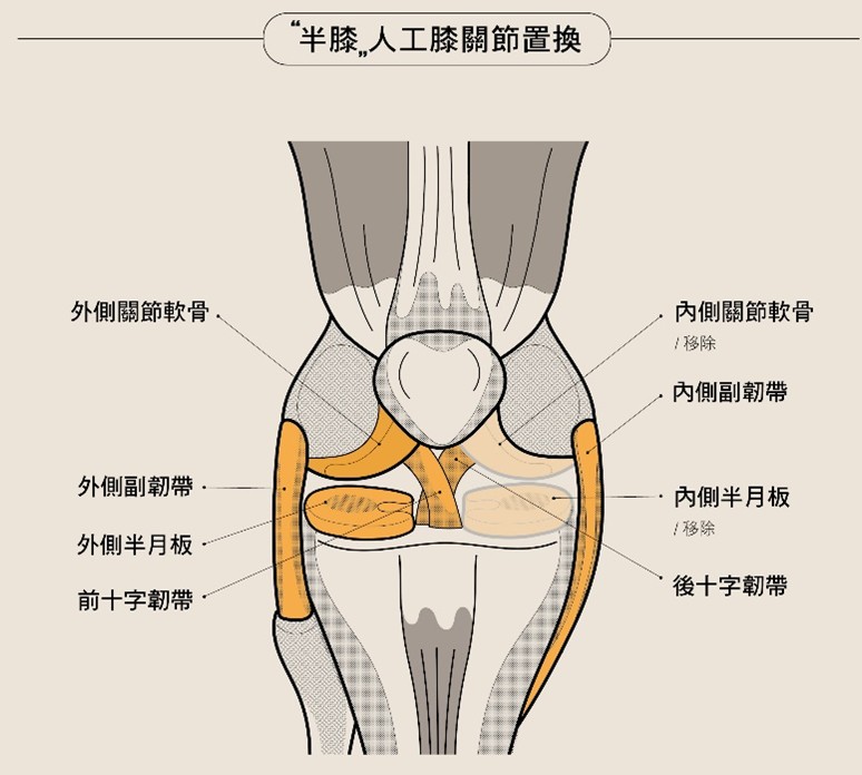 個人化半人工膝關節僅僅以植入物取代少部分關節面