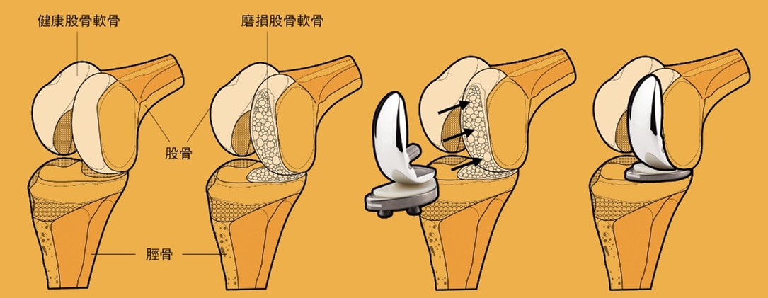 個人化半人工膝關節