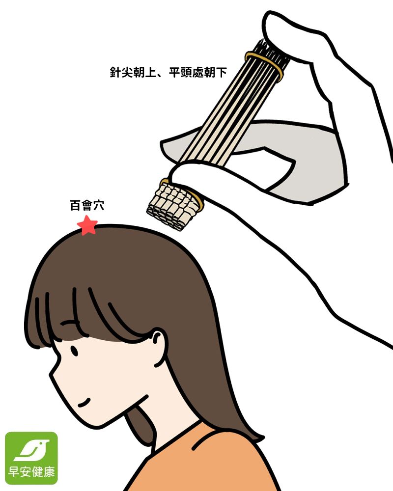 牙籤療法使用示意圖