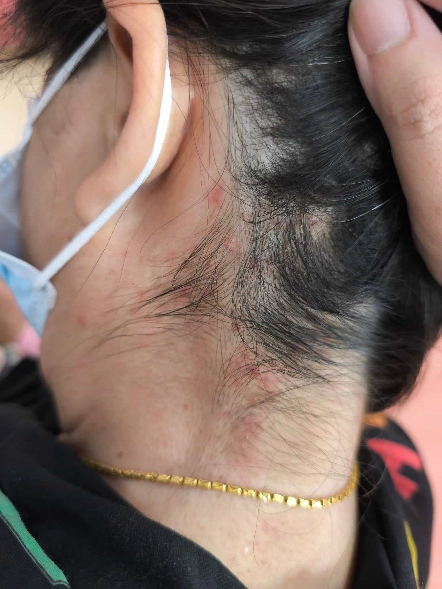 皮膚專科烏惟新醫師_頭癬1