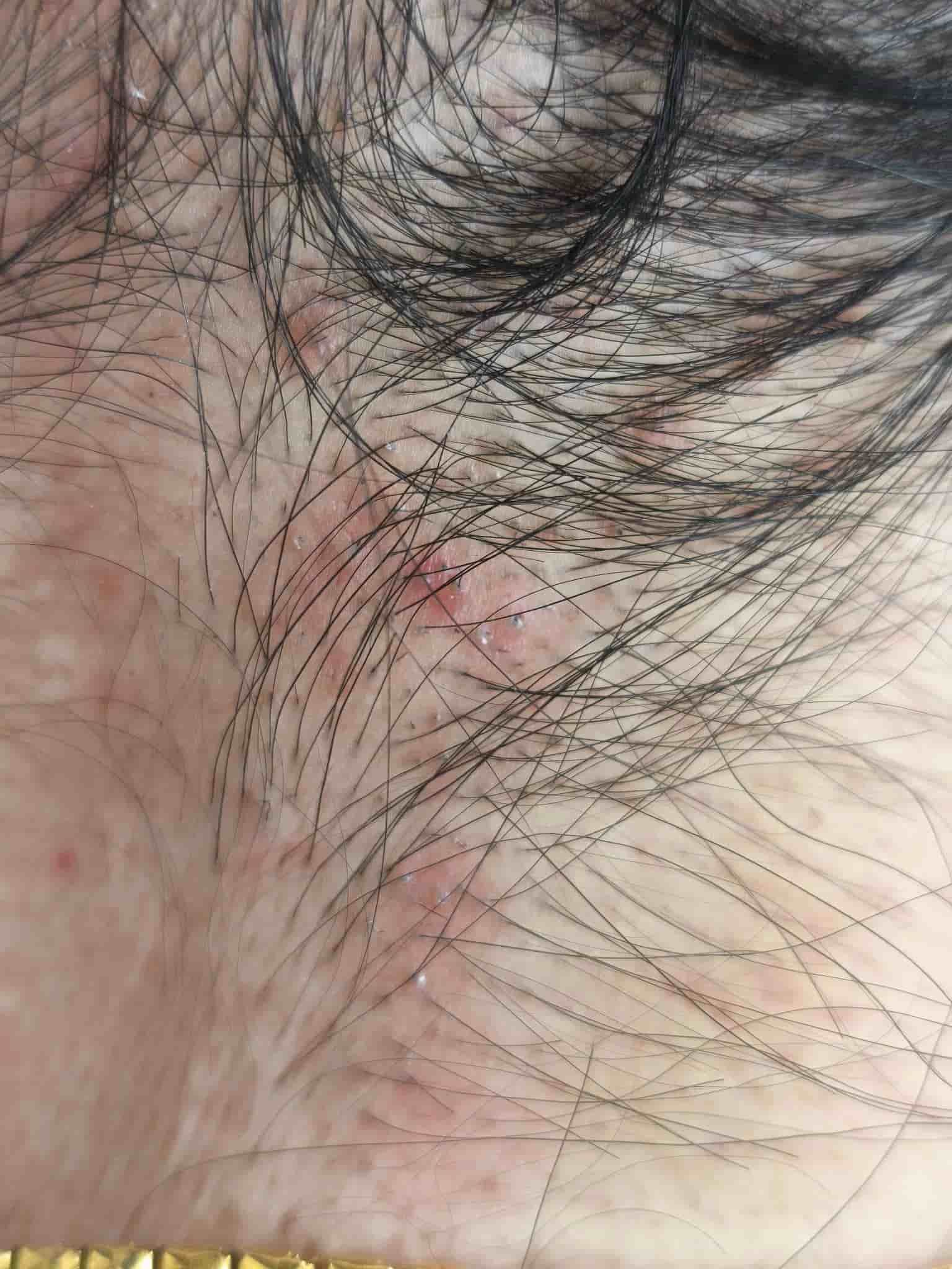 皮膚專科烏惟新醫師_頭癬2