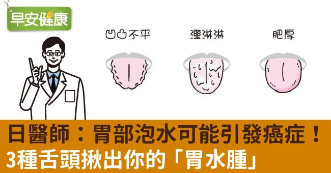 日醫師：胃部泡水可能引發癌症！3種舌頭揪出你的「胃水腫」