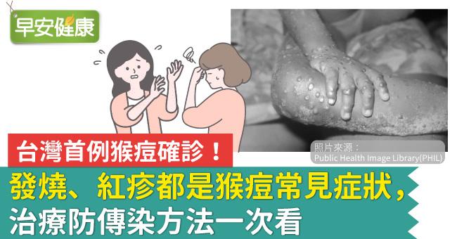 台灣首例猴痘確診！發燒、紅疹都是猴痘常見症...