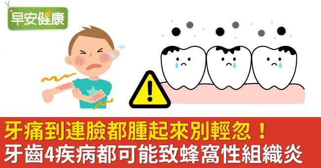 牙痛到連臉都腫起來別輕忽！牙齒4疾病都可能致蜂窩性組織炎