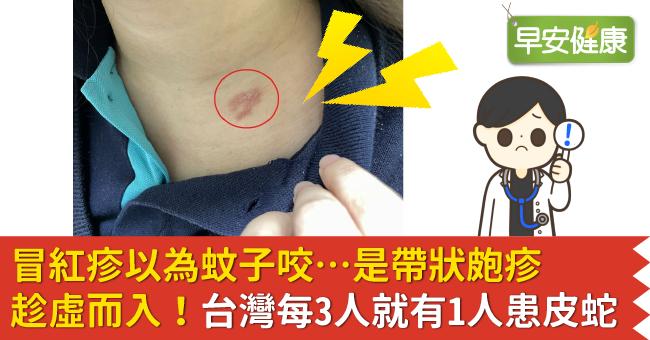 冒紅疹以為蚊子咬…是帶狀皰疹趁虛而入！台灣每3人就有1人患皮蛇