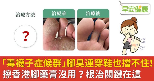 「毒襪子症候群」腳臭連穿鞋也擋不住！擦香港腳藥膏沒用？根治關鍵在這