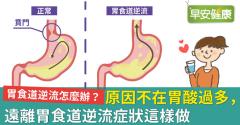 胃食道逆流症狀不只火燒心、咳嗽，原因更不是胃酸過多！胃食道逆流緊急處理怎麼辦？可以吃什麼？改善胃食道逆流飲食穴道方法懶人包