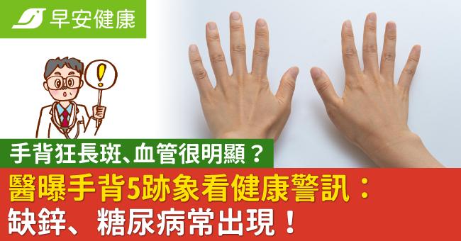 手背狂長斑、血管很明顯？醫曝手背5跡象看健康警訊：缺鋅、糖尿病常出現！