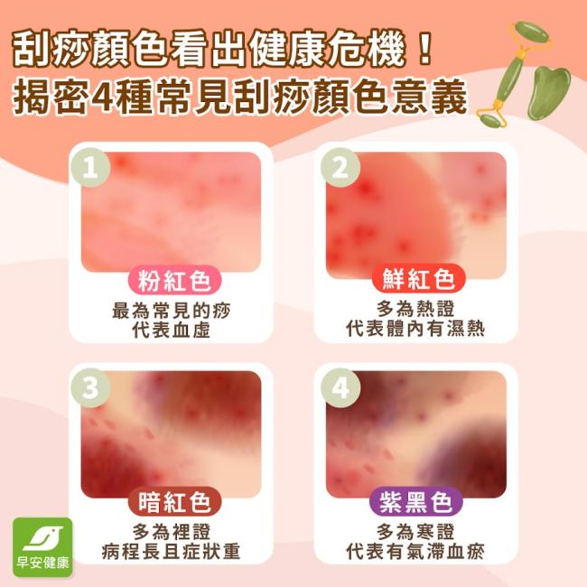 刮痧原理是什麼？刮痧好處、顏色＆位置、禁忌注意事項