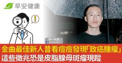 金曲最佳新人昔看痘痘發現「致癌腫瘤」這些徵兆恐是皮脂腺母斑瘤現蹤