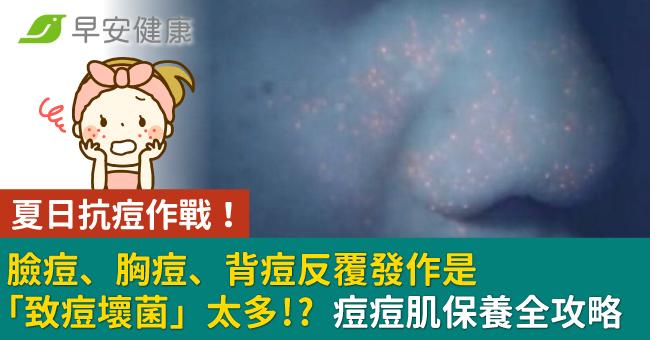 夏日抗痘作戰！臉痘、胸痘、背痘反覆發作是「...