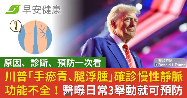 川普「手瘀青、腿浮腫」確診慢性靜脈功能不全...