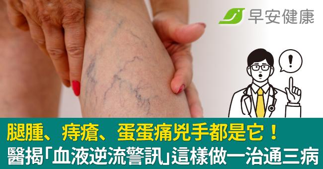 腿腫、痔瘡、蛋蛋痛兇手都是它!醫揭「血液逆流警訊」這樣做一治通三病